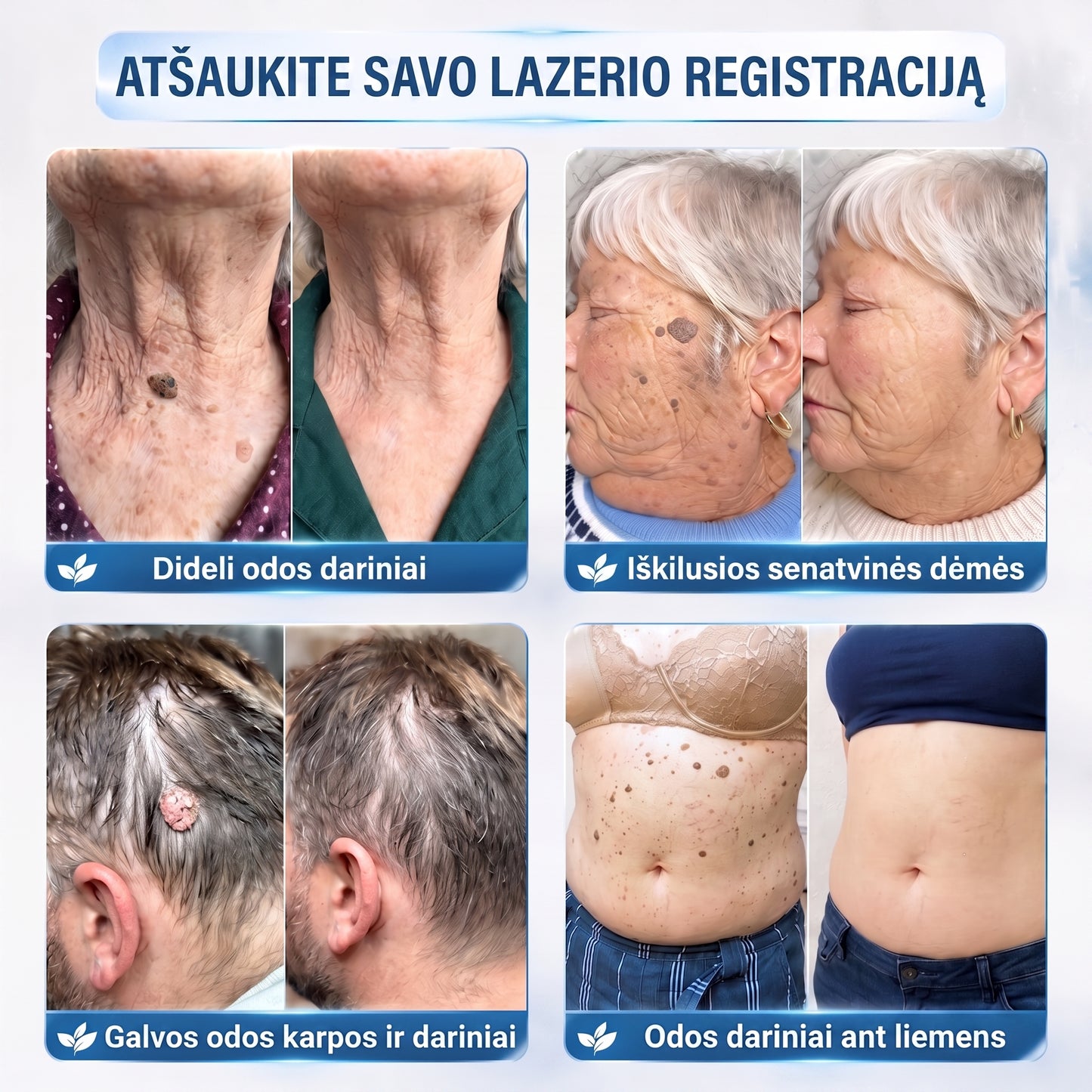 🐝🐝Oficiali parduotuvė | ✅️👩‍⚕️ 𝐇𝐈𝐒𝐊𝐈𝐍® 7 dienų odos išaugų ir dėmių šalinimo priemonė (𝐫𝐨𝐥𝐥-𝐨𝐧 𝐚𝐩𝐥𝐢𝐤𝐚𝐭𝐨𝐫𝐢𝐮𝐬: 𝐛𝐞 𝐬𝐤𝐚𝐮𝐬𝐦𝐨 𝐢𝐫 𝐫𝐚𝐧𝐝ų) 🌳